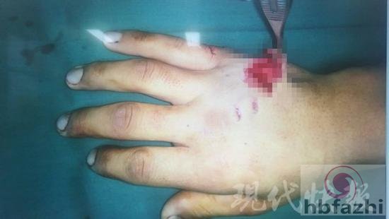 萌宠变猛宠！宠物鳄鱼击袭主人致手背撕裂